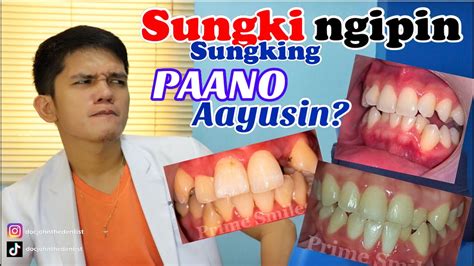 Sungki Na Ngipin .